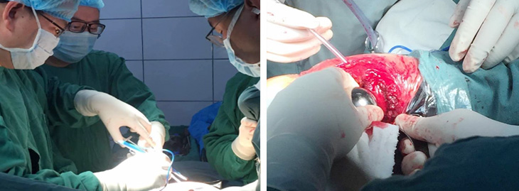 骨科股骨头置换术(图1)