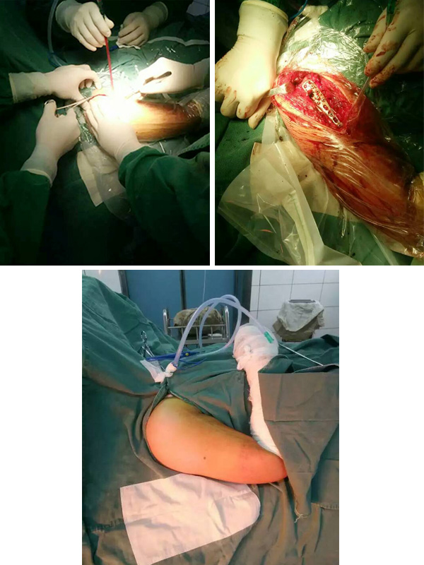 成功完成一例右肱骨骨折固定术(图1)