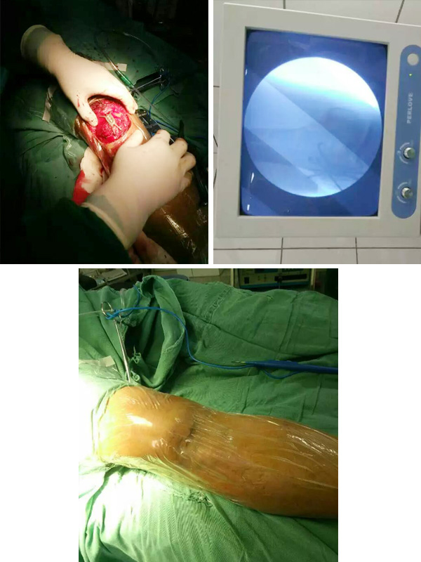 成功完成一例髌骨粉碎性骨折固定术(图1)